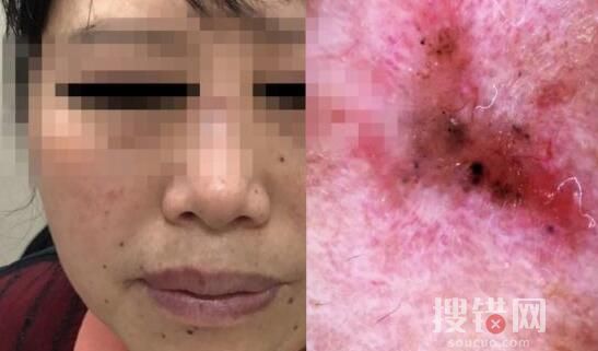 女子陪閨蜜就診自己卻被查出癌癥 幸好來得早