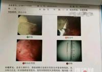 寶媽稱醫院誤將針掉進孩子胃中 為什么掉進胃中？