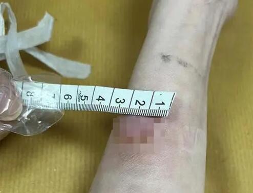 女子稱卷發棒爆炸致手臂二度燙傷 真相揭露真的令人大吃一驚