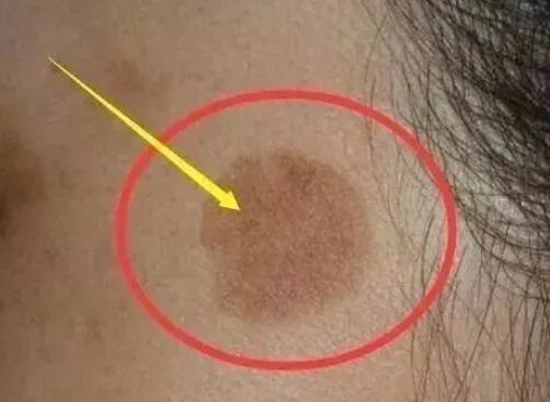 25歲女生長期熬夜長出老年斑 真相揭露真的令人大吃一驚