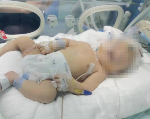 嬰兒出生后顱骨骨折 醫院回應 結果真的令人大吃一驚