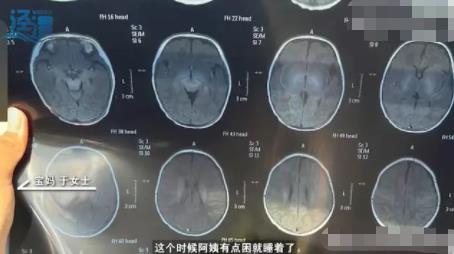 月嫂拍嗝時打盹致嬰兒頭頂骨骨折 真相曝光簡直太驚人了