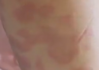 女孩打水光針全身過敏出紅斑 事件始末2025最新消息